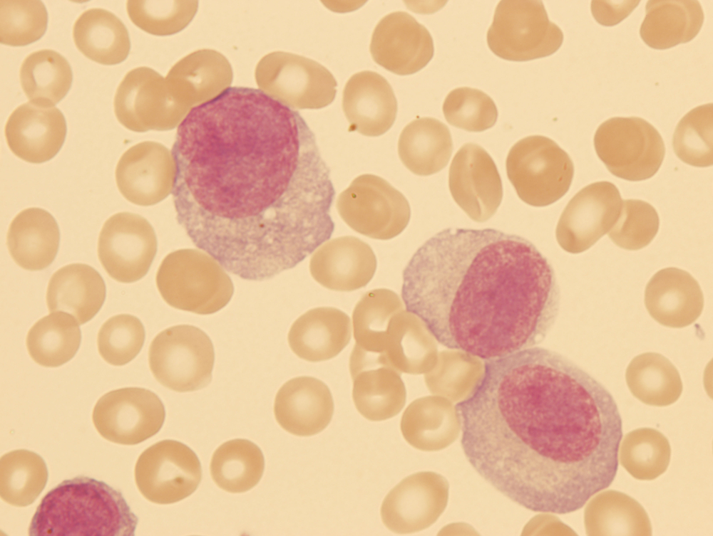 leukemia leukaemia