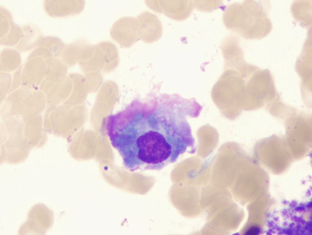 multiple myeloma