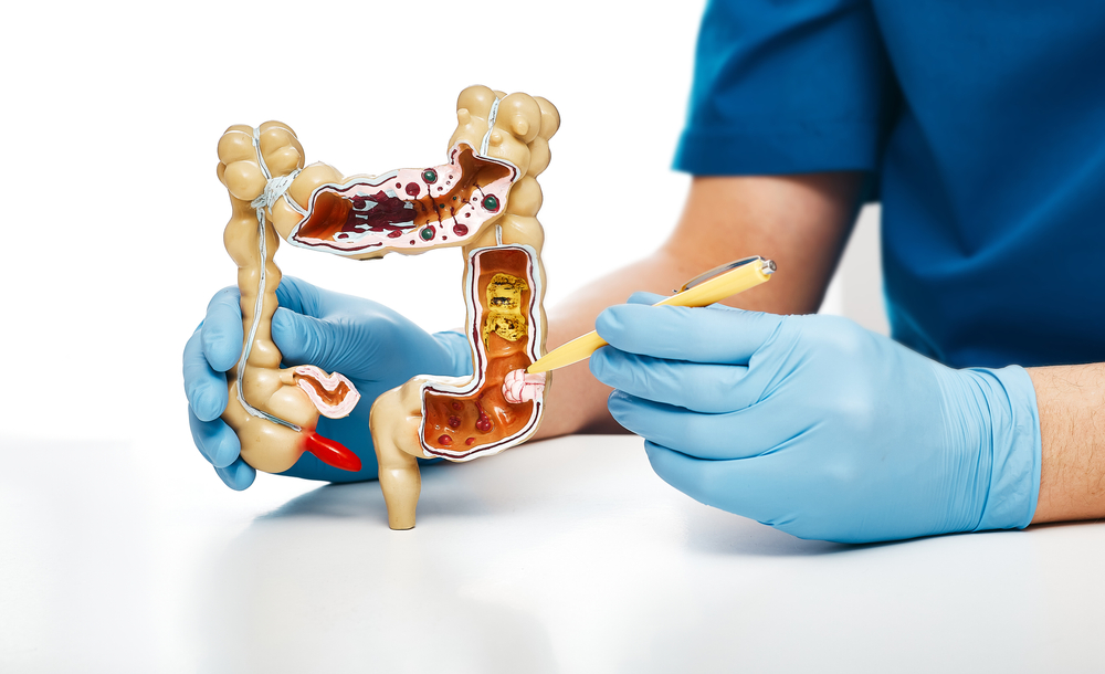 gastrointestinal cancer