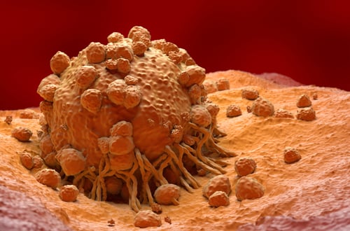 melanoma cells