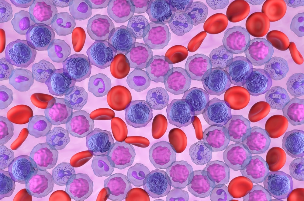 acute myeloid leukaemia AML leukemia