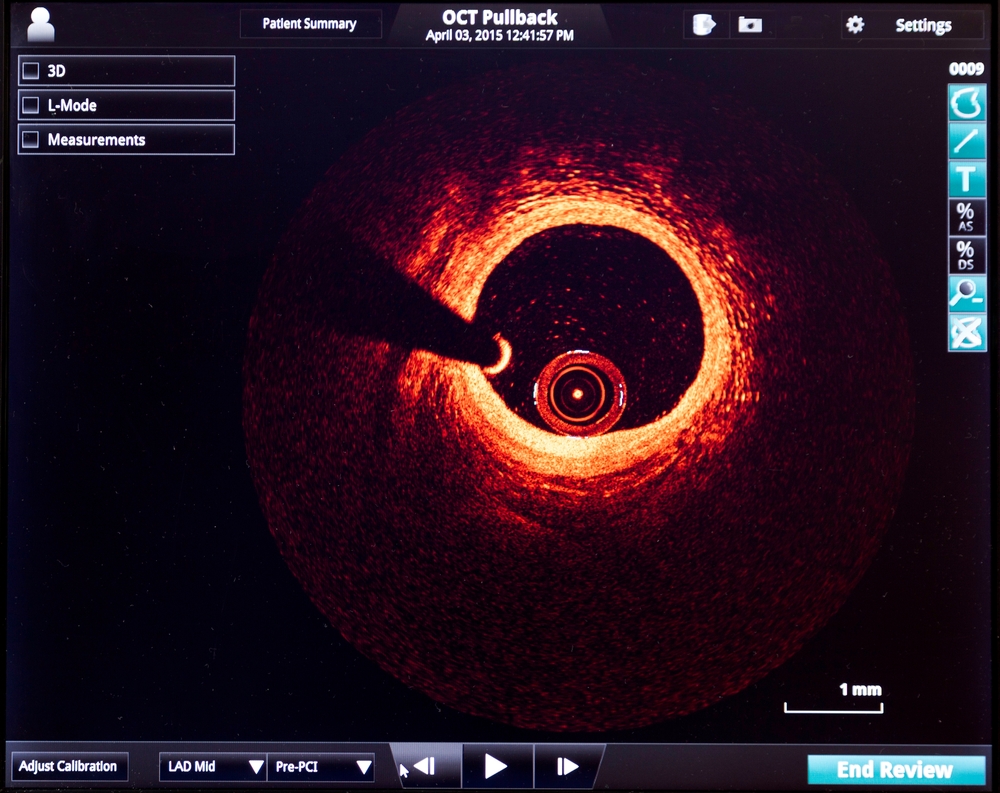 atherosclerosis