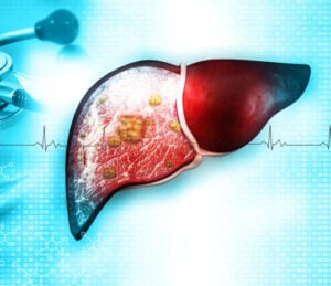 liver cancer