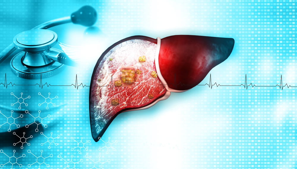 liver cancer