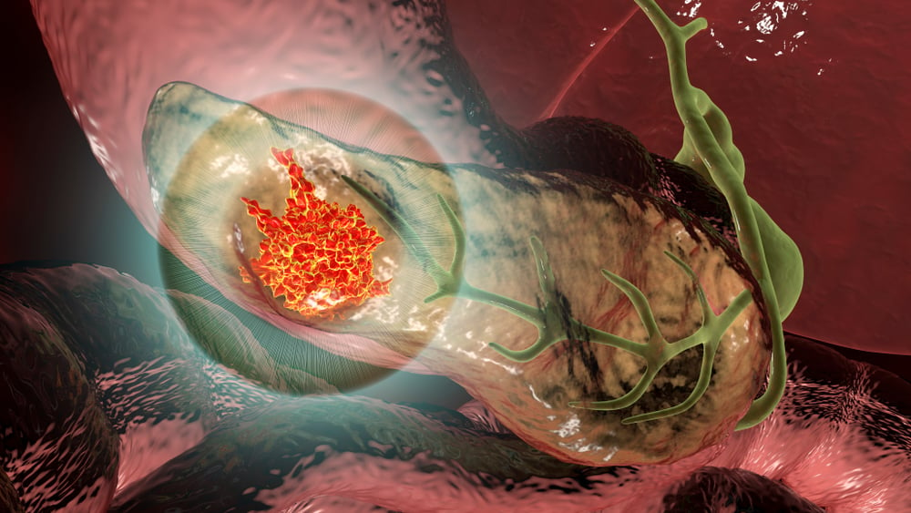 pancreas pancreatic cancer