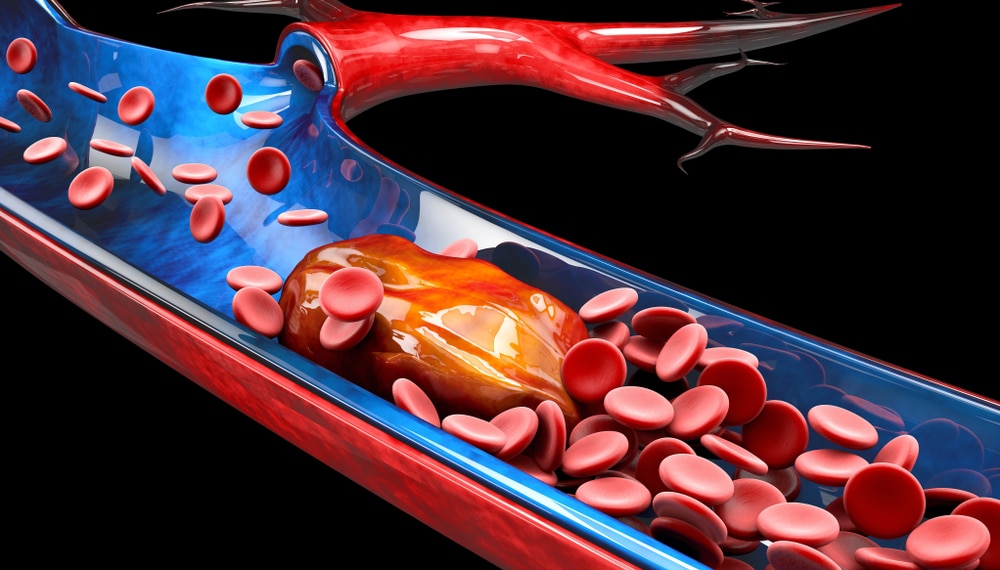 deep vein thrombosis