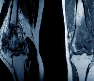 osteosarcoma