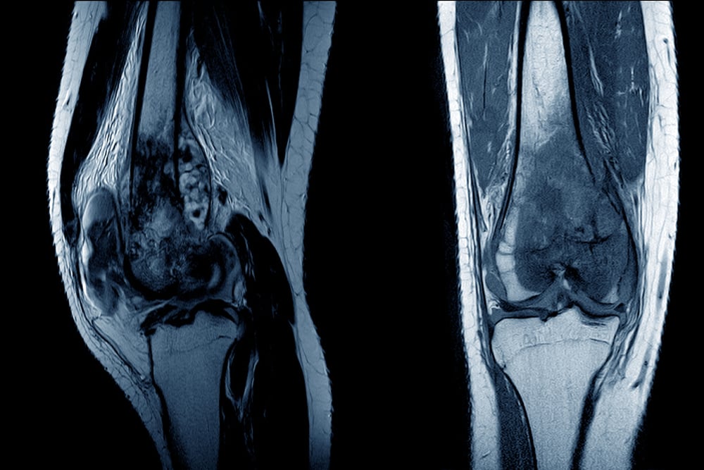 osteosarcoma