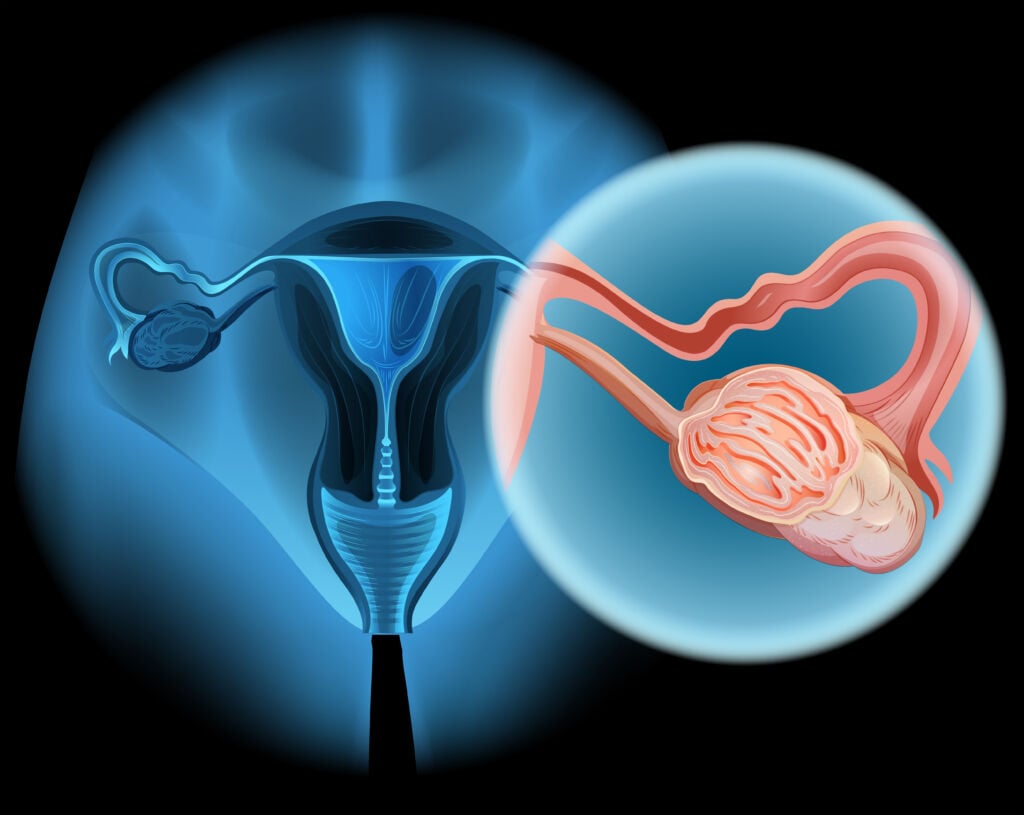 ovarian cancer