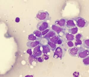 Ewing sarcoma