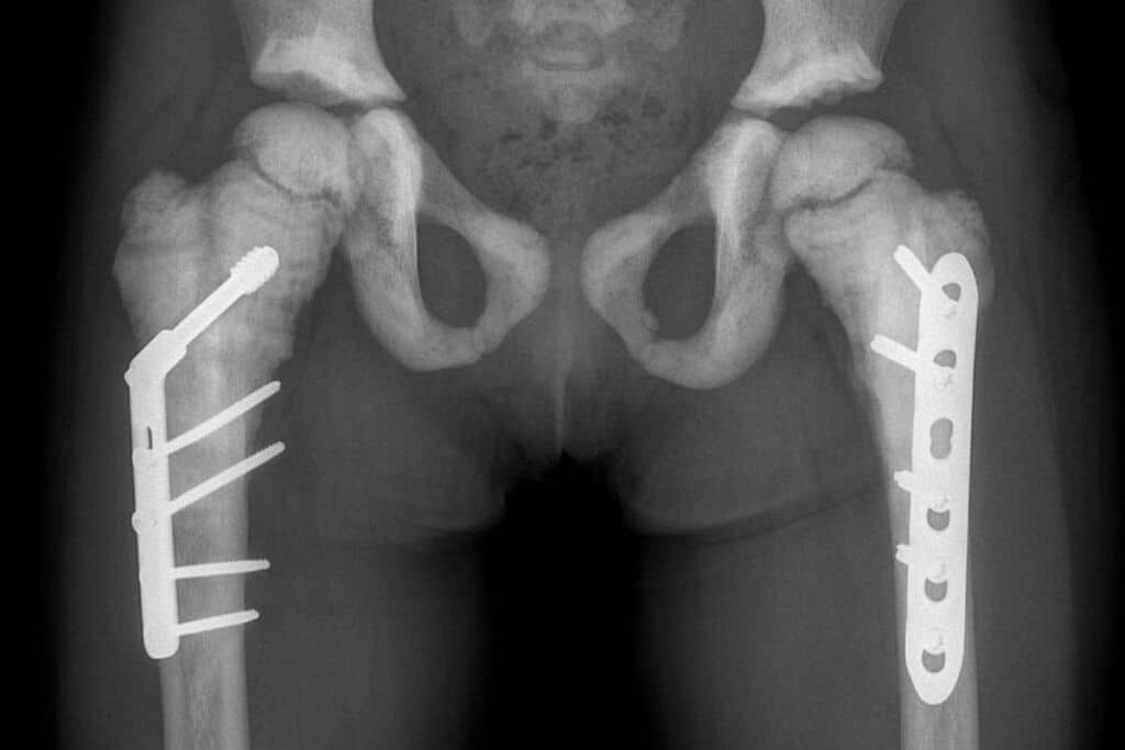 Osteopetrosis ADO2 radiopaedia case ID 8037