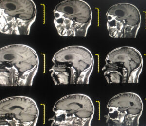 brain cancer tumor glioblastoma tumour