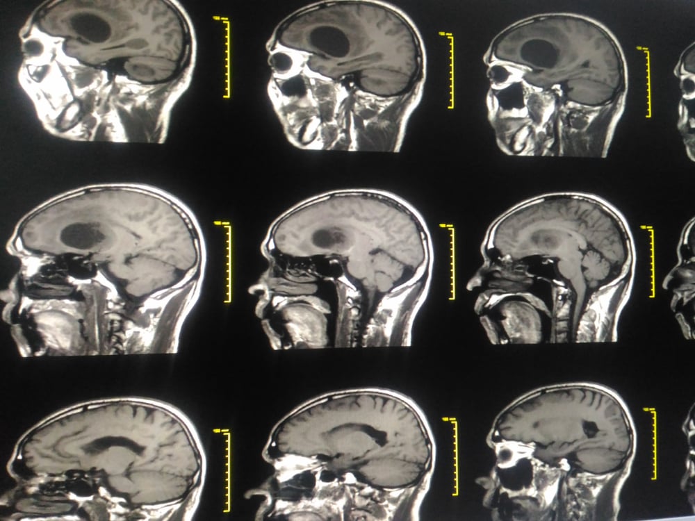 brain cancer tumor glioblastoma tumour