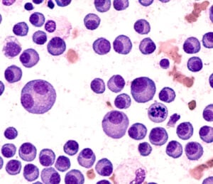 multiple myeloma