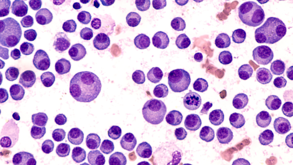 multiple myeloma