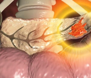 pancreatic cancer pancreas