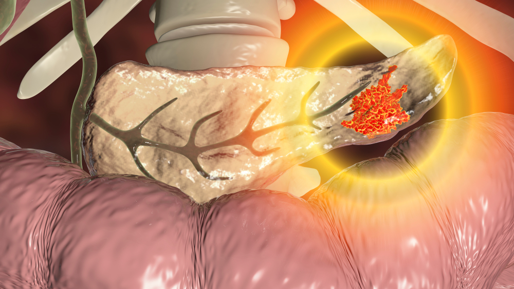 pancreatic cancer pancreas