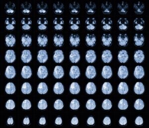 brain glioblastoma