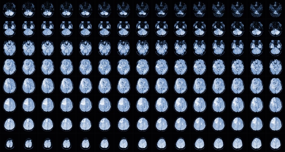 brain glioblastoma