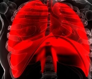 pulmonary sarcoidosis