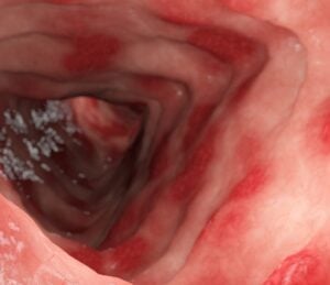 ulcerative colitis