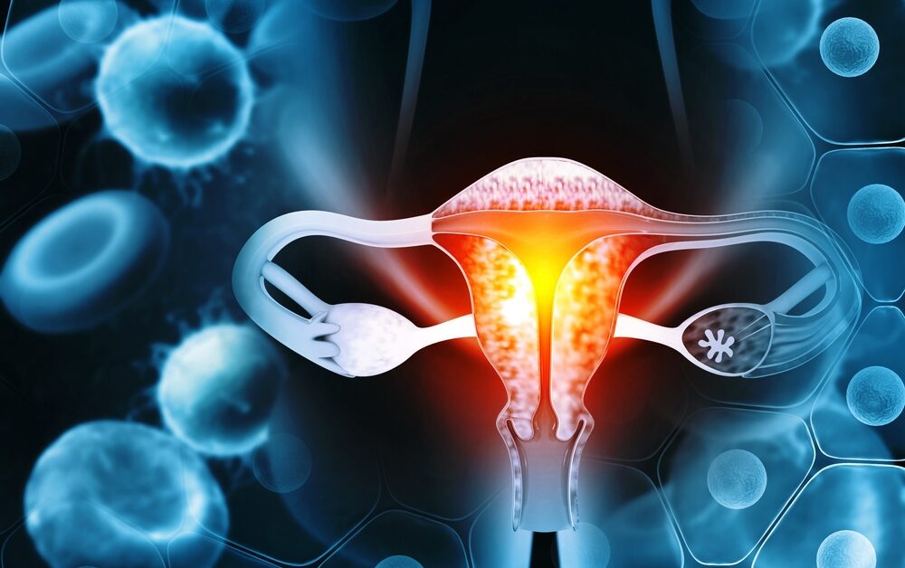 endometrial cancer