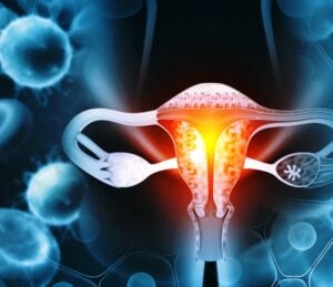 endometrial cancer