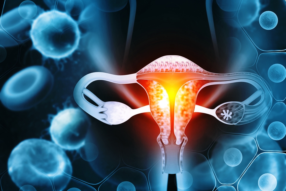 endometrial cancer