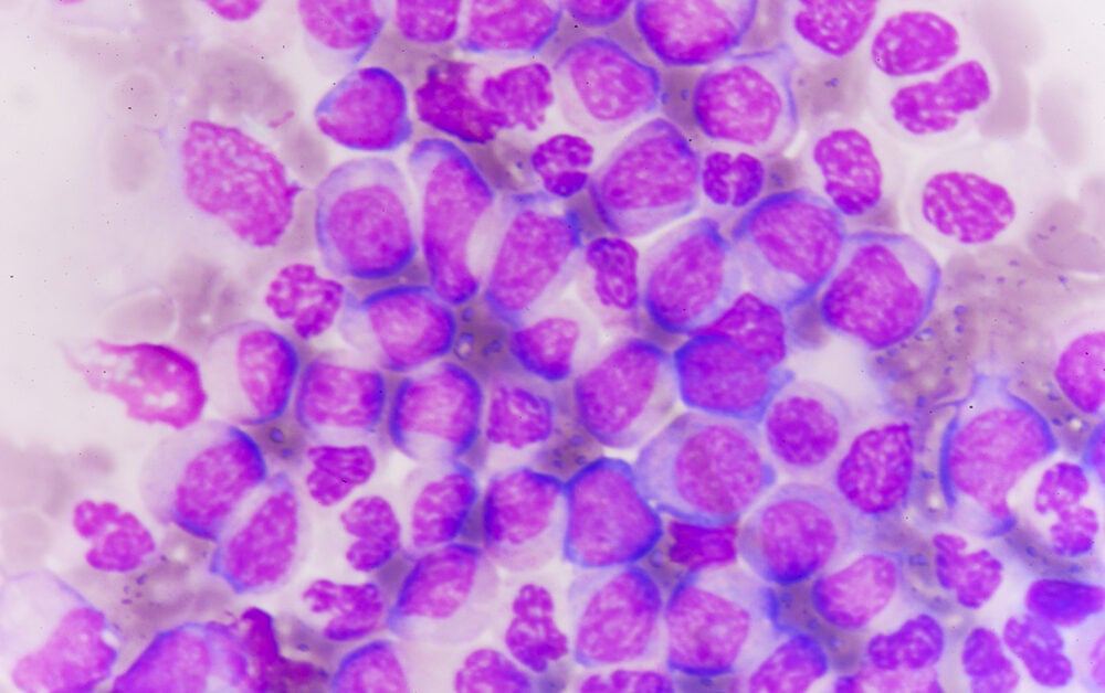 acute myeloid leukemia AML leukaemia