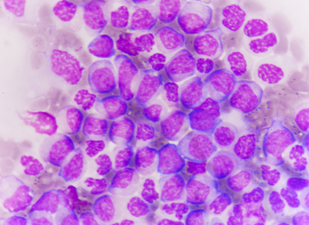 acute myeloid leukemia AML leukaemia