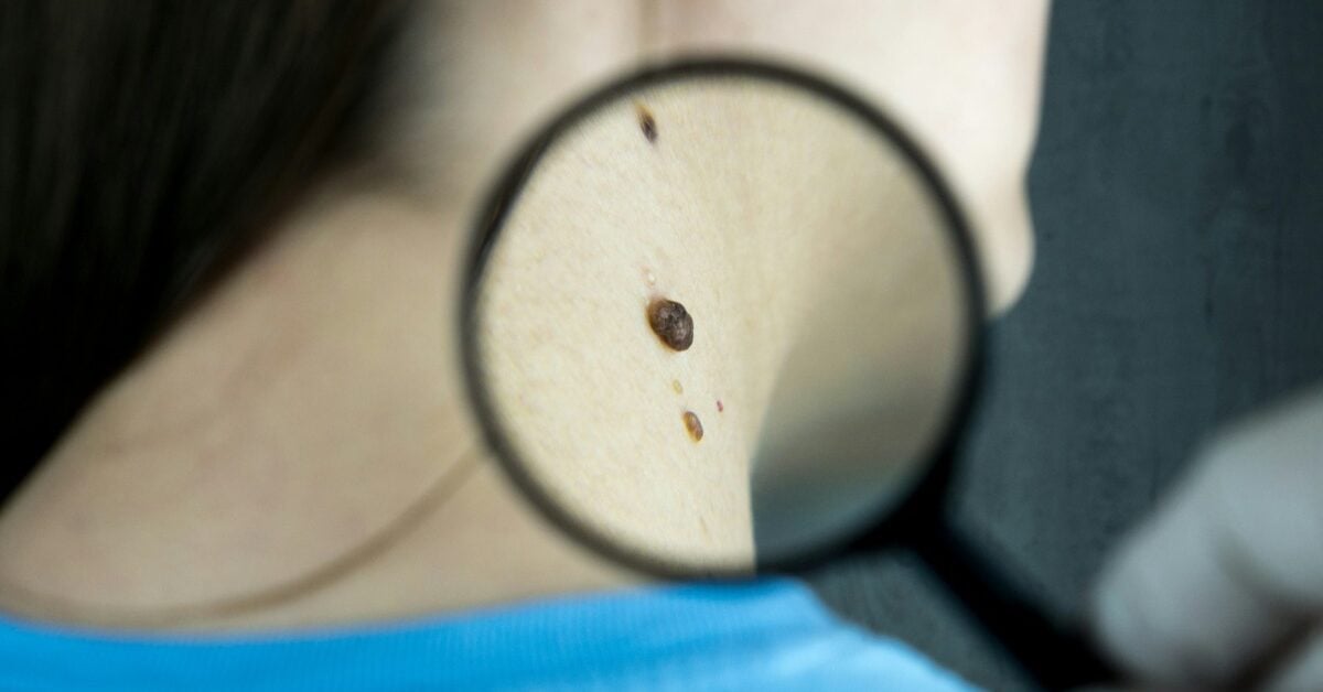 Melanoma vaccines