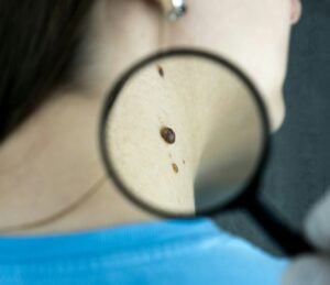 Melanoma vaccines