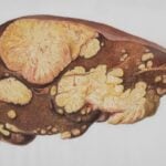 Cure for hepatitis B