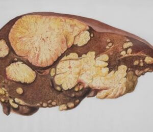 Cure for hepatitis B